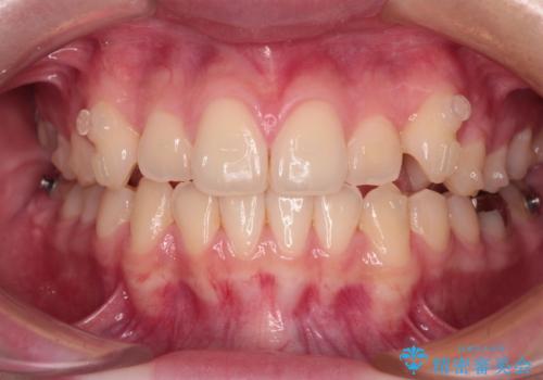 八重歯を確実に改善 補助装置を併用したインビザライン矯正治療の治療中
