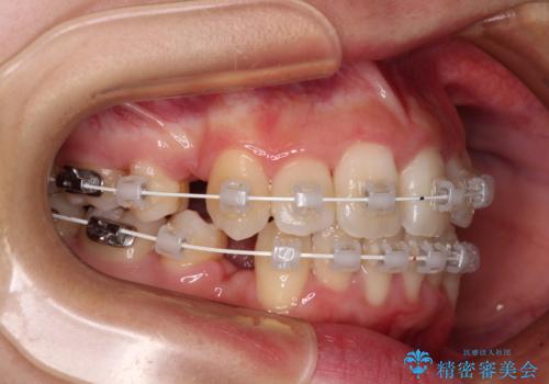 デコボコと出っ歯　抜歯矯正でスッキリとした口元にの治療中