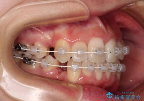 デコボコと出っ歯 抜歯矯正でスッキリとした口元にの治療中