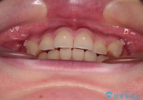 八重歯を確実に改善 補助装置を併用したインビザライン矯正治療の治療中