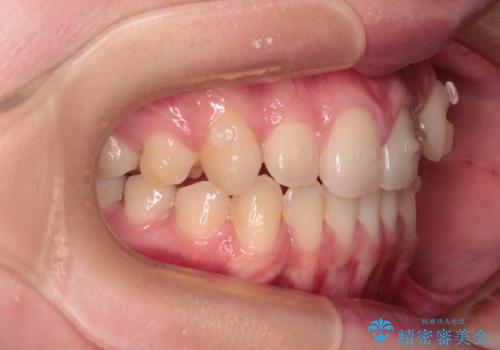 八重歯を確実に改善 補助装置を併用したインビザライン矯正治療の治療中