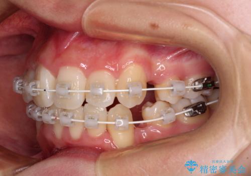 デコボコと出っ歯　抜歯矯正でスッキリとした口元にの治療中