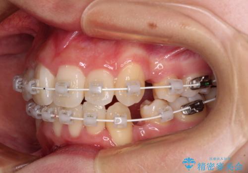 デコボコと出っ歯 抜歯矯正でスッキリとした口元にの治療中