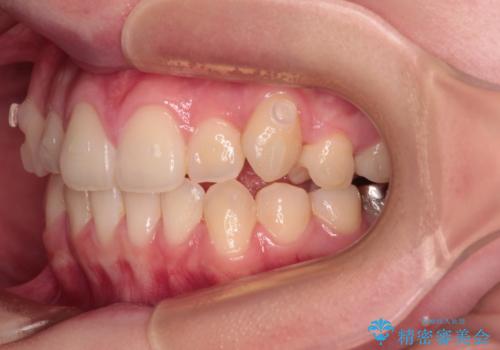 八重歯を確実に改善 補助装置を併用したインビザライン矯正治療の治療中