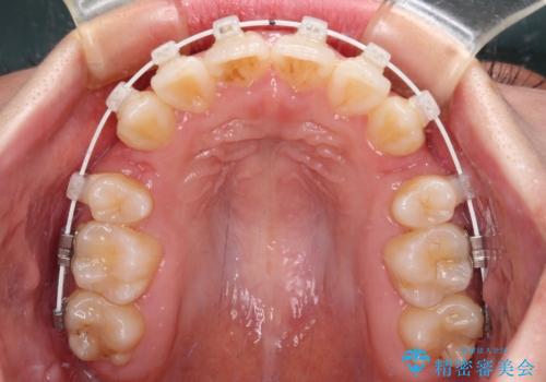 デコボコと出っ歯 抜歯矯正でスッキリとした口元にの治療中