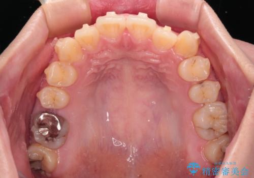 八重歯を確実に改善　補助装置を併用したインビザライン矯正治療の治療中
