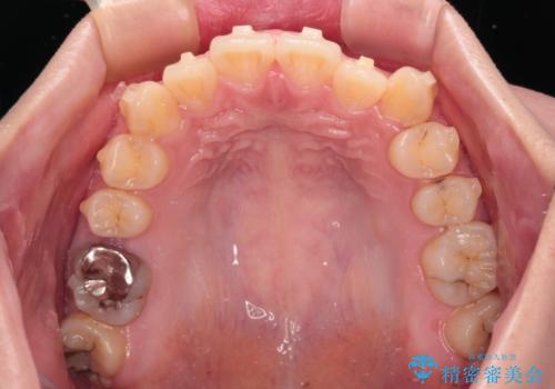 八重歯を確実に改善 補助装置を併用したインビザライン矯正治療の治療中