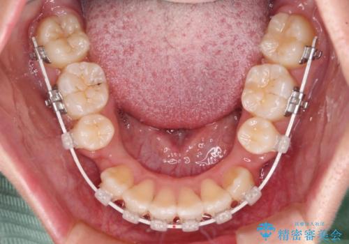 デコボコと出っ歯 抜歯矯正でスッキリとした口元にの治療中