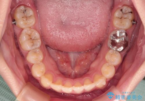 八重歯を確実に改善 補助装置を併用したインビザライン矯正治療の治療中