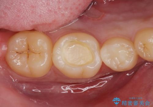 古い樹脂を除去してe-maxインレーの治療中