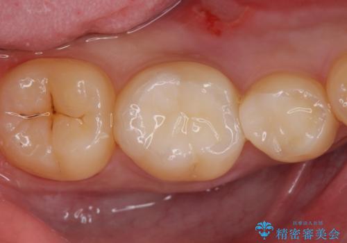 古い樹脂を除去してe-maxインレーの治療後