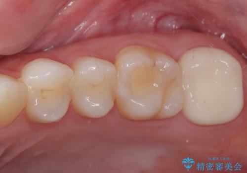 詰め物の下に虫歯があると言われた　オールセラミッククラウンの治療後