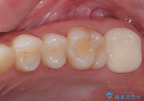 詰め物の下に虫歯があると言われた オールセラミッククラウンの治療後