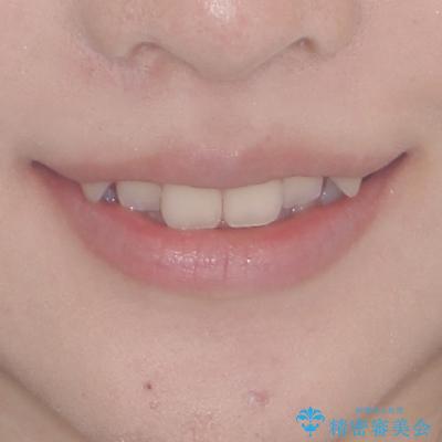 八重歯を確実に改善 補助装置を併用したインビザライン矯正治療の治療前(顔貌)