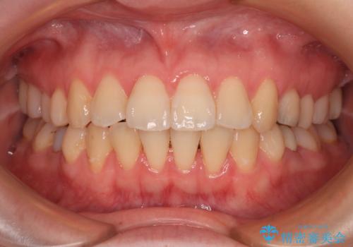 開咬と前方に飛び出した前歯 インビザラインによる矯正治療の治療中