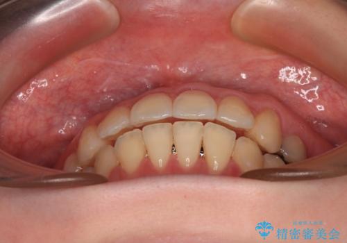 開咬と前方に飛び出した前歯 インビザラインによる矯正治療の治療中