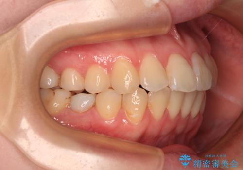 開咬と前方に飛び出した前歯 インビザラインによる矯正治療の治療中