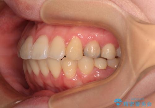 開咬と前方に飛び出した前歯 インビザラインによる矯正治療の治療中