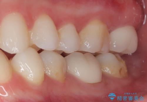 詰め物の下に虫歯があると言われた オールセラミッククラウンの治療後