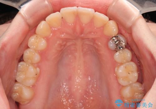 開咬と前方に飛び出した前歯 インビザラインによる矯正治療の治療中