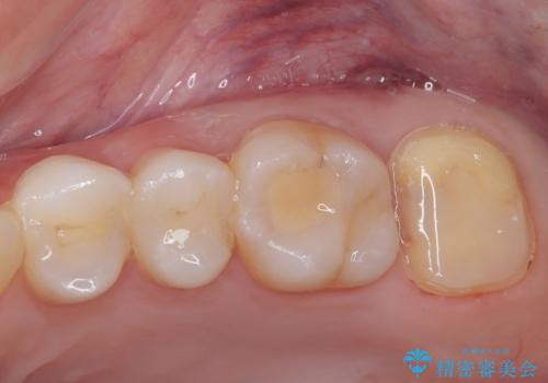 詰め物の下に虫歯があると言われた　オールセラミッククラウンの治療中