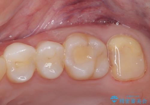 詰め物の下に虫歯があると言われた オールセラミッククラウンの治療中