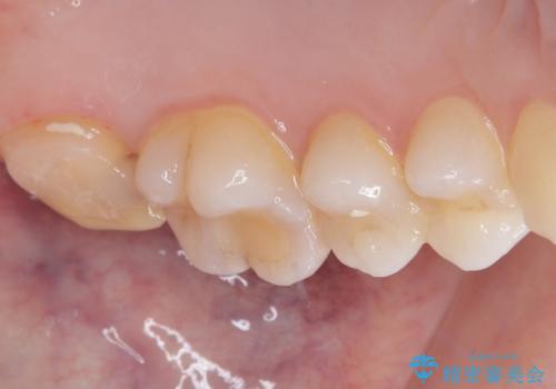 詰め物の下に虫歯があると言われた オールセラミッククラウンの治療中