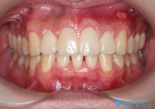 マウスピース矯正で前歯の角度、ガタガタをきれいにの症例 治療後