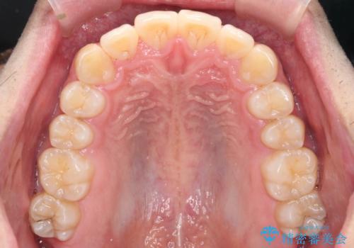 マウスピース矯正で前歯の角度、ガタガタをきれいにの治療後