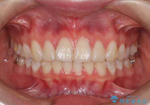 前歯のガタつきを治したい 翼状捻転マウスピース矯正の治療中