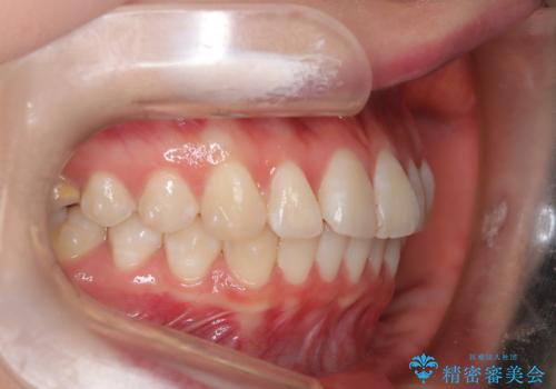 前歯のガタつきを治したい 翼状捻転マウスピース矯正の治療中