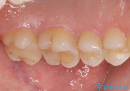 詰め物の下に虫歯があると言われた オールセラミッククラウンの治療前