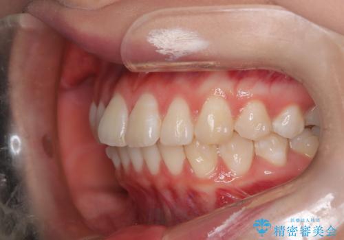 前歯のガタつきを治したい 翼状捻転マウスピース矯正の治療中