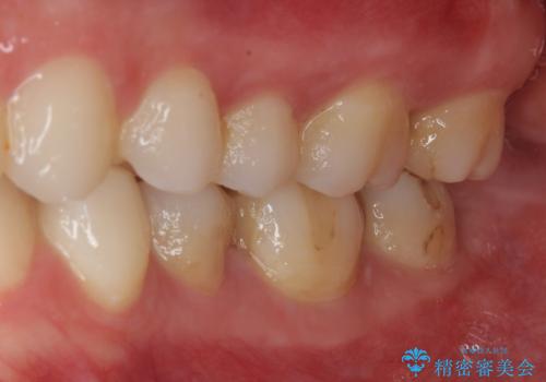 詰め物の下に虫歯があると言われた オールセラミッククラウンの治療前