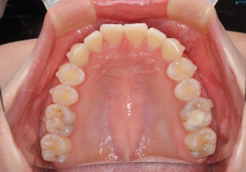 前歯のガタつきを治したい 翼状捻転マウスピース矯正の治療中
