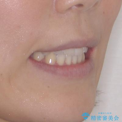 閉じにくい口元をワイヤー抜歯矯正でスッキリ改善の治療後(顔貌)