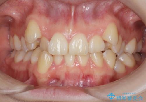 [ 八重歯を治す ]   小臼歯4本抜歯 マルチブラケット矯正の症例 治療前