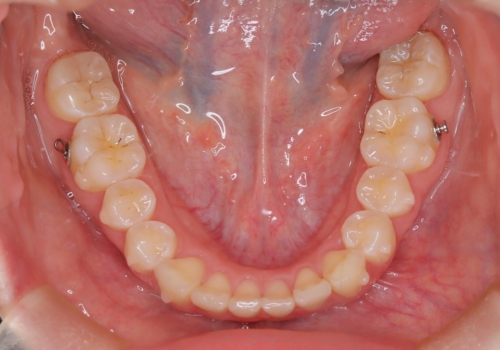 前歯のガタつきを治したい 翼状捻転マウスピース矯正の治療中