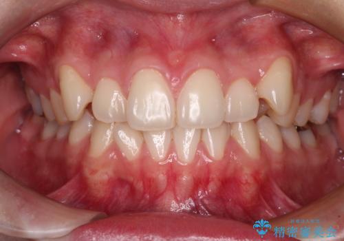 八重歯を確実に改善　補助装置を併用したインビザライン矯正治療の症例 治療前