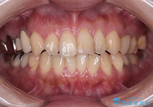 前歯をきれいにしたい オールセラミッククラウンの症例 治療前