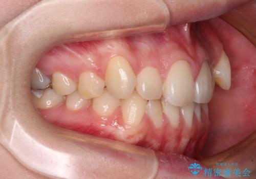 八重歯を確実に改善 補助装置を併用したインビザライン矯正治療の治療前