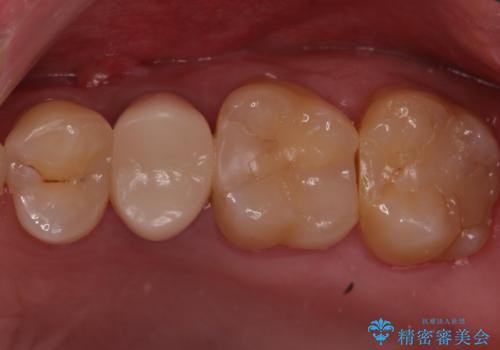 歯茎が腫れてきた。再根管治療の症例 治療前