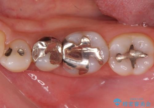 銀歯から精度の良い補綴物への症例 治療前