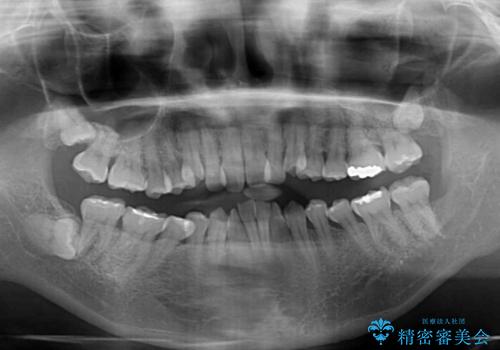 飛び出した上顎前歯と上下のデコボコ 片顎の抜歯によるワイヤー矯正の治療前