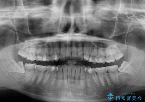 前歯のデコボコを解消 インビザラインの矯正治療の治療前