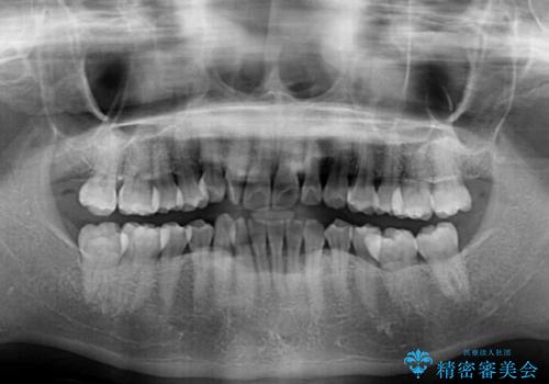【モニター】上顎前突と奥歯の鋏状咬合　補助装置を用いたインビザライン矯正治療の治療前