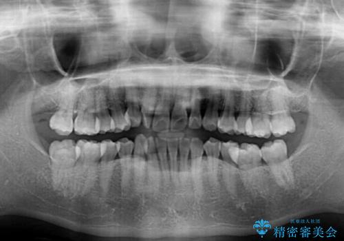 【モニター】上顎前突と奥歯の鋏状咬合 補助装置を用いたインビザライン矯正治療の治療前