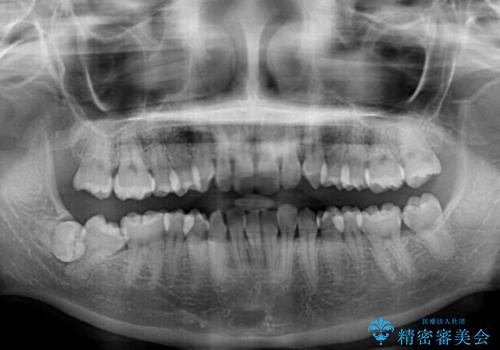 埋もれた奥歯をワイヤーで改善　インビザラインによる矯正治療の治療前
