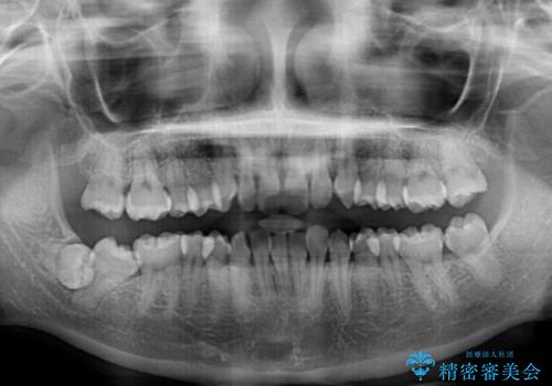 埋もれた奥歯をワイヤーで改善 インビザラインによる矯正治療の治療前