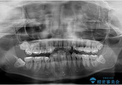 【モニター】顎のゆがみをカムフラージュ ワイヤー装置の抜歯矯正の治療前